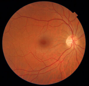 Retinal-imaging-eye-exams-victoria-bc